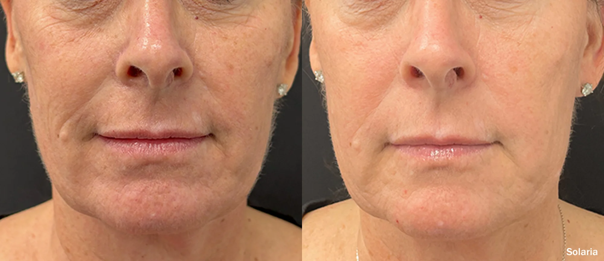 Laser Resurfacing a gallery-by Sei-Tu-Bella-Aesthetics-in-Tampa-FL