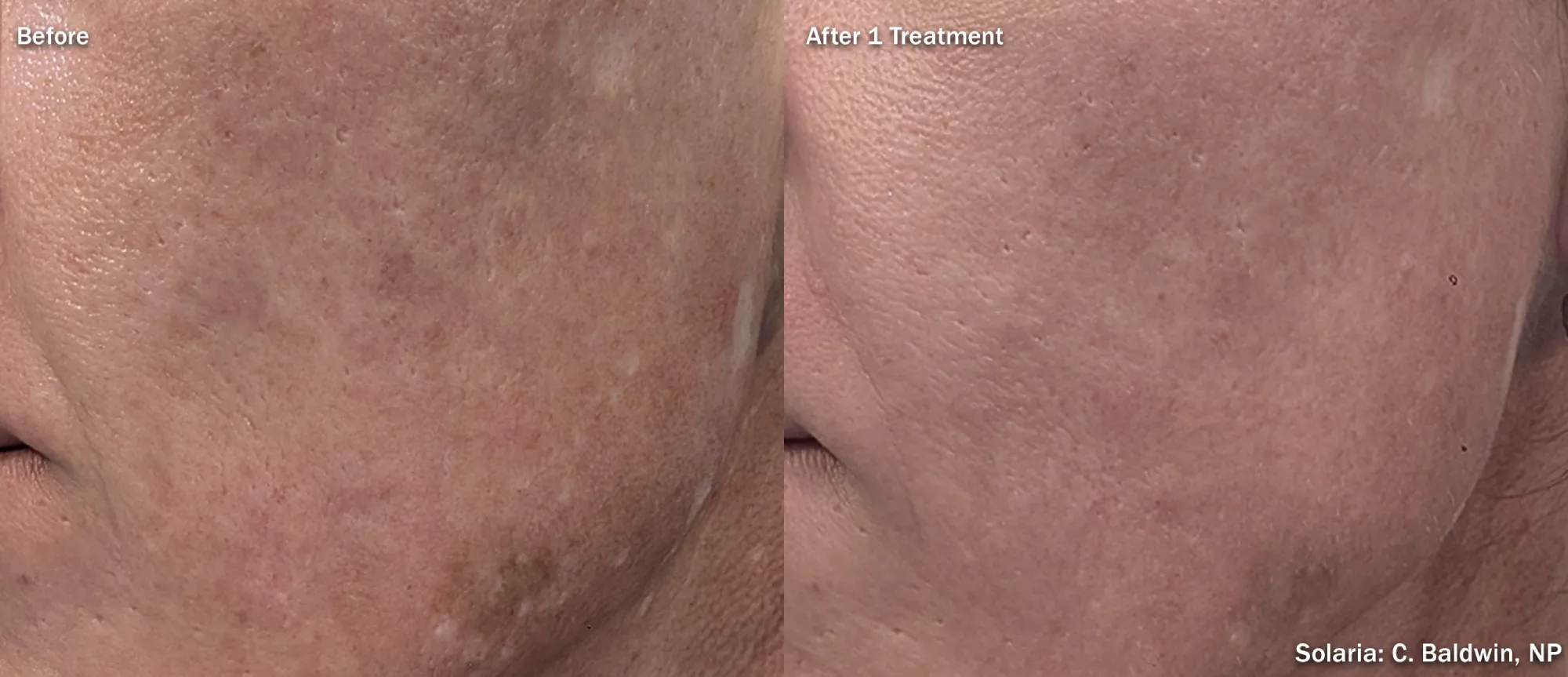 Laser Resurfacing b gallery-by Sei-Tu-Bella-Aesthetics-in-Tampa-FL