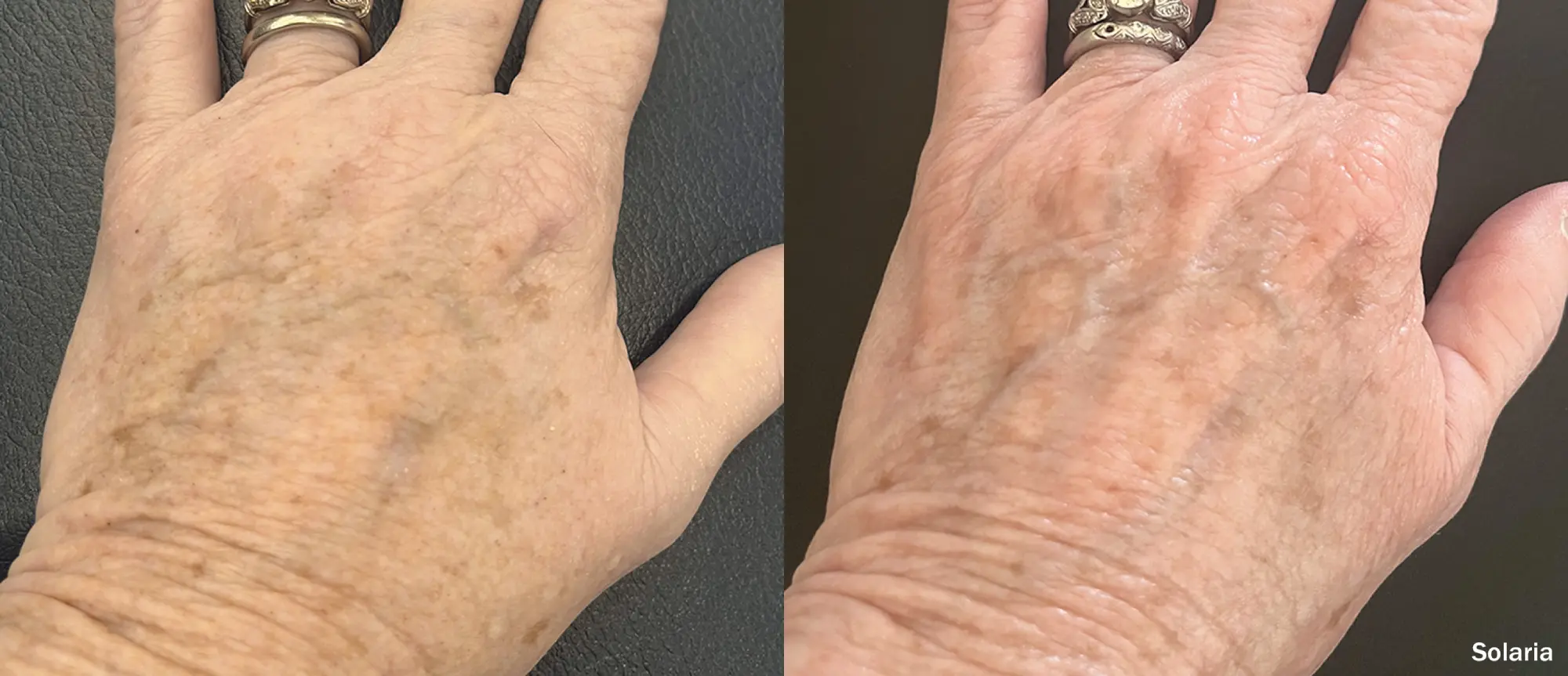 Laser Resurfacing c gallery-by Sei-Tu-Bella-Aesthetics-in-Tampa-FL