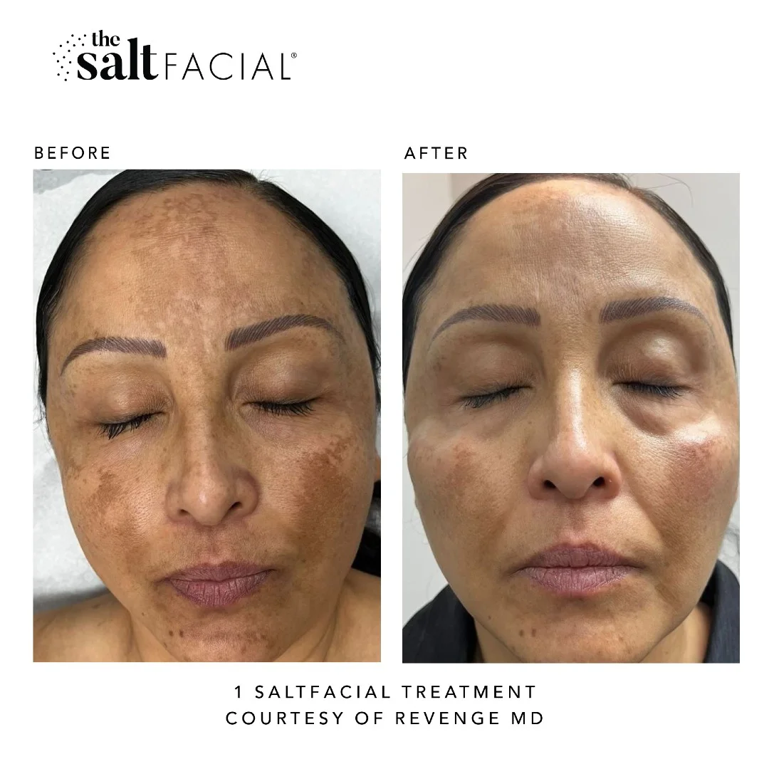 SaltFacial a gallery-by Sei-Tu-Bella-Aesthetics-in-Tampa-FL