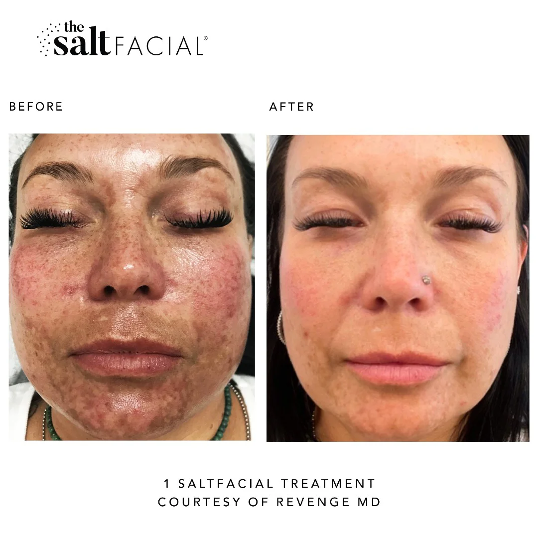 SaltFacial b gallery-by Sei-Tu-Bella-Aesthetics-in-Tampa-FL