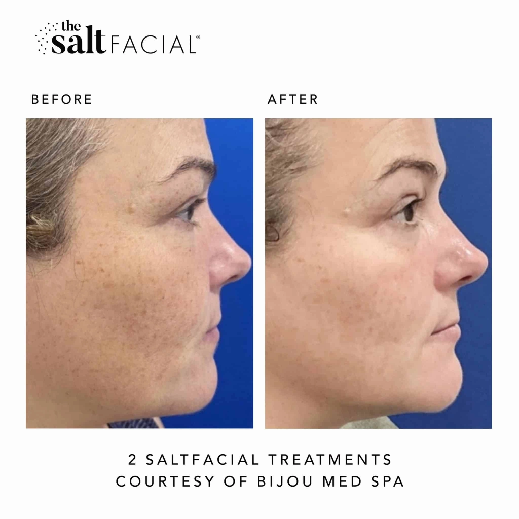 SaltFacial c gallery-by Sei-Tu-Bella-Aesthetics-in-Tampa-FL