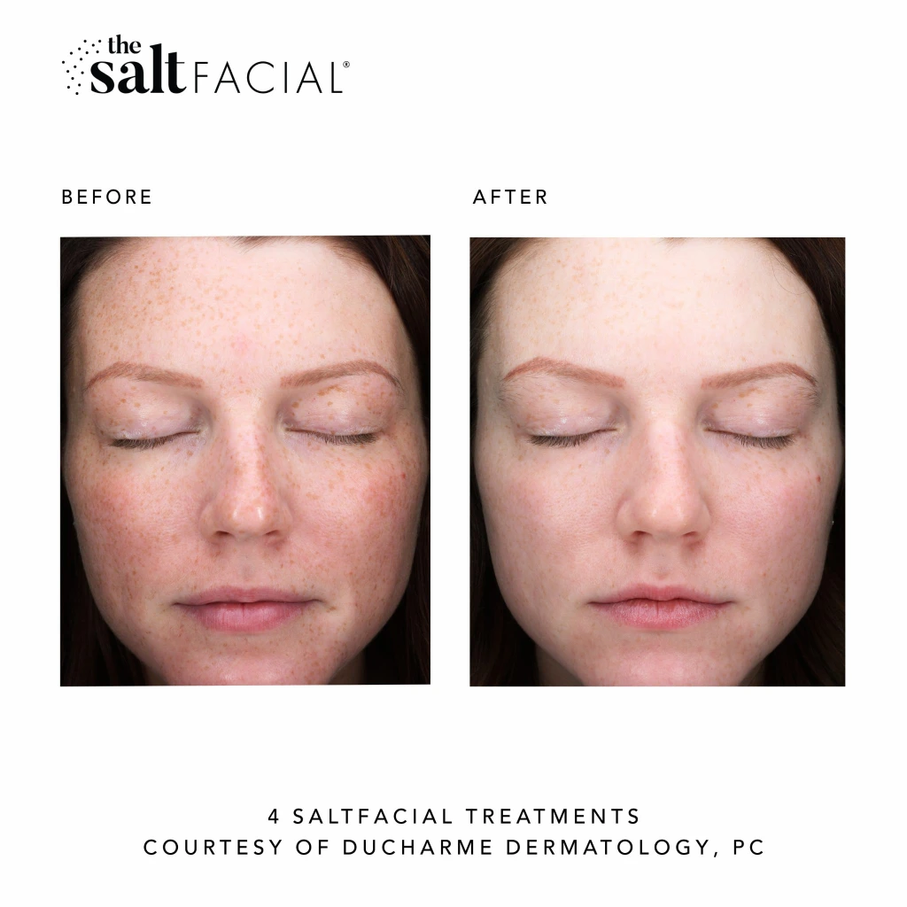 SaltFacial d gallery-by Sei-Tu-Bella-Aesthetics-in-Tampa-FL