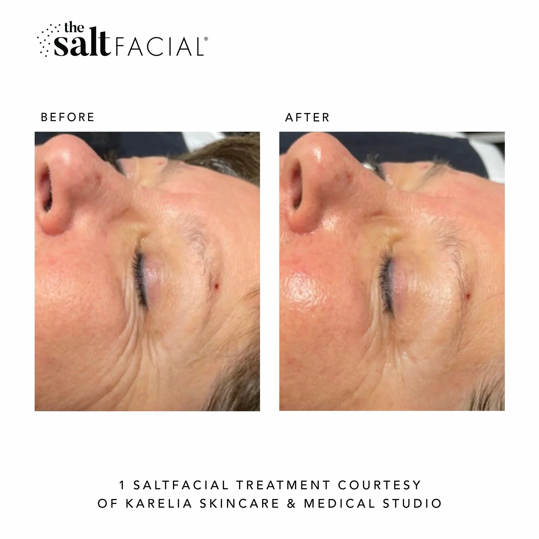 SaltFacial e gallery-by Sei-Tu-Bella-Aesthetics-in-Tampa-FL