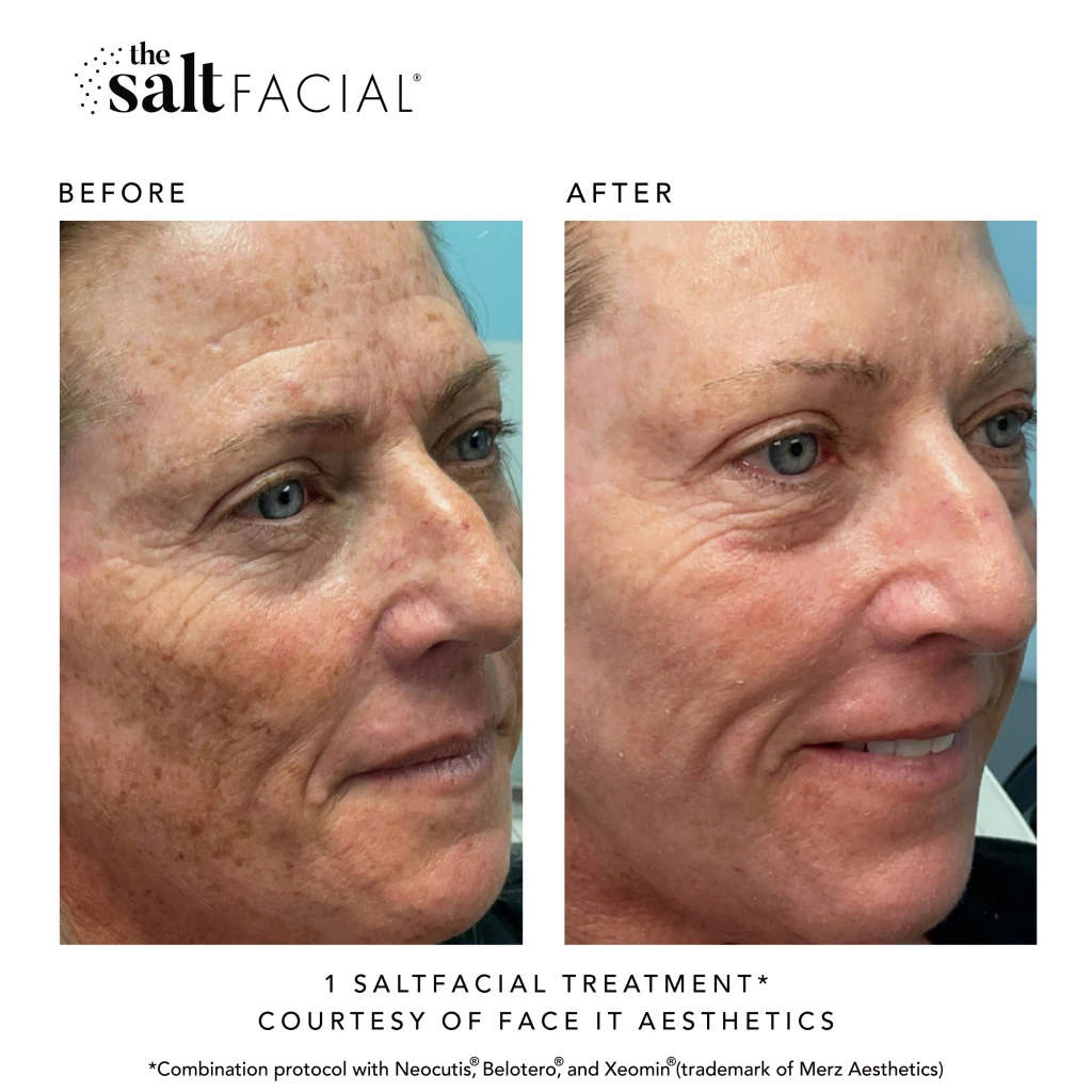 SaltFacial f gallery-by Sei-Tu-Bella-Aesthetics-in-Tampa-FL