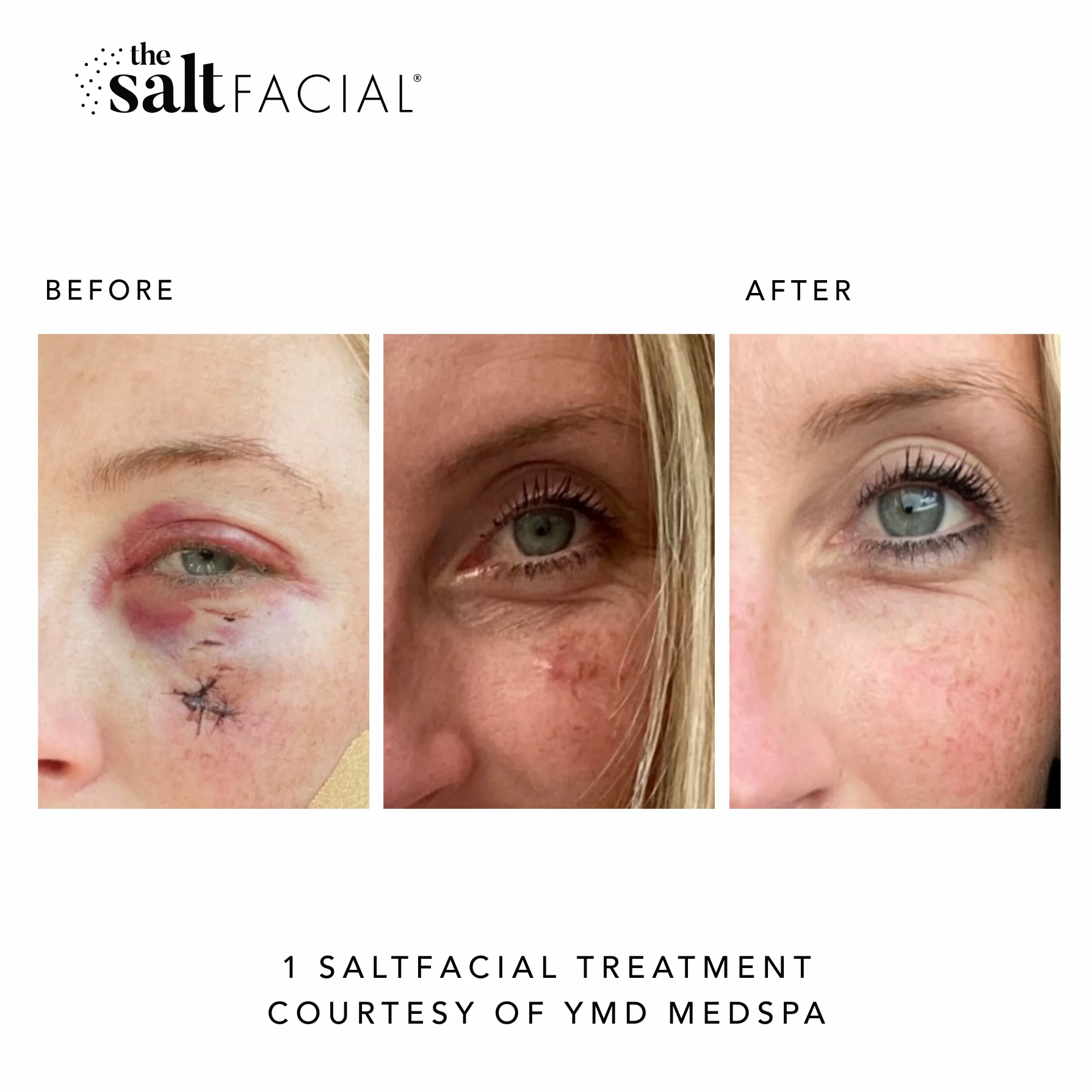SaltFacial g gallery-by Sei-Tu-Bella-Aesthetics-in-Tampa-FL