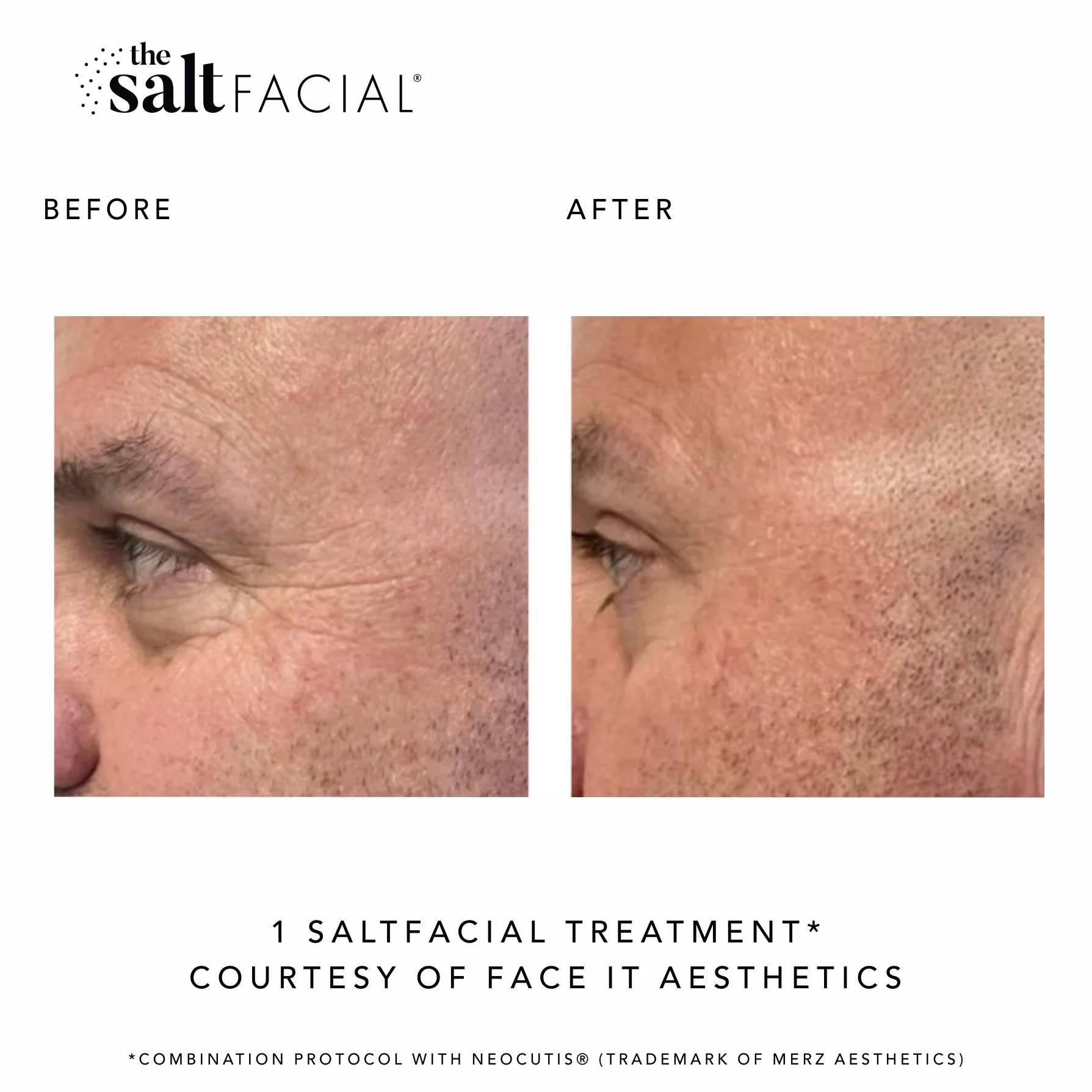 SaltFacial h gallery-by Sei-Tu-Bella-Aesthetics-in-Tampa-FL