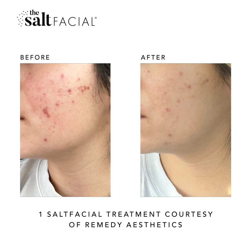 SaltFacial i gallery-by Sei-Tu-Bella-Aesthetics-in-Tampa-FL