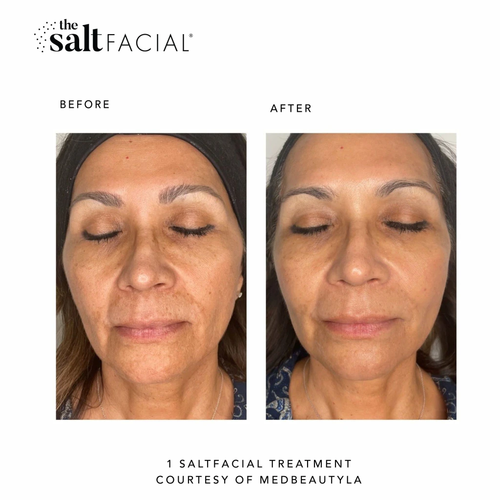 SaltFacial j gallery-by Sei-Tu-Bella-Aesthetics-in-Tampa-FL
