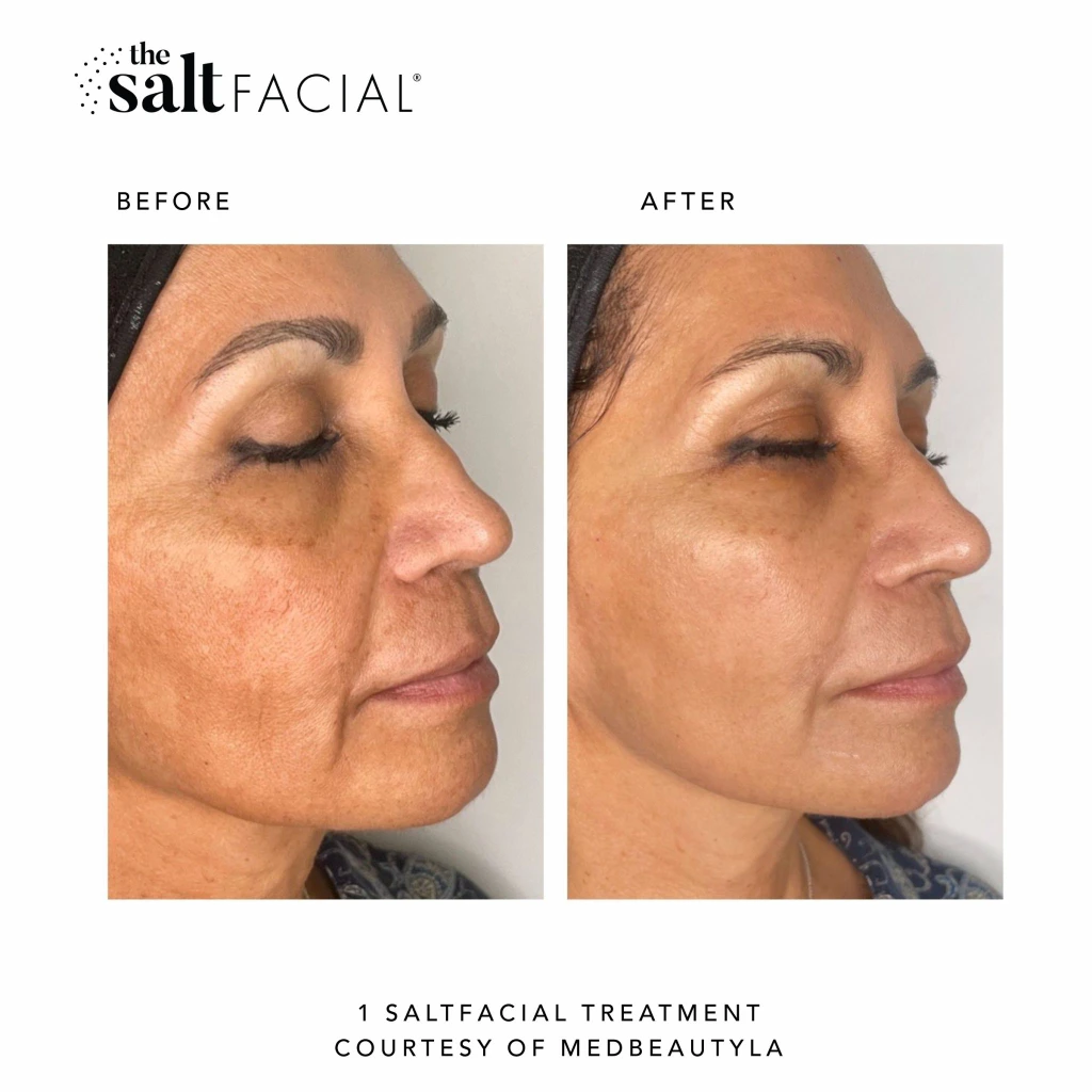 SaltFacial k gallery-by Sei-Tu-Bella-Aesthetics-in-Tampa-FL