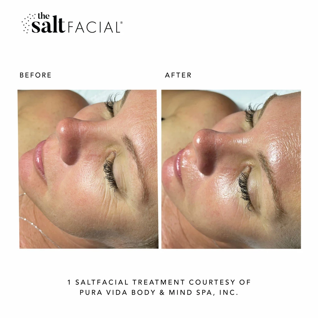 SaltFacial l gallery-by Sei-Tu-Bella-Aesthetics-in-Tampa-FL