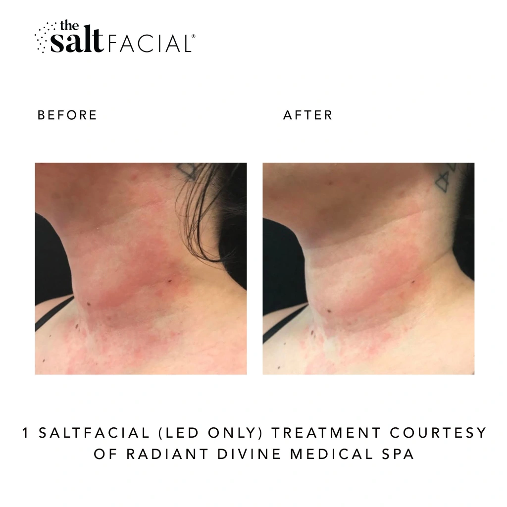 SaltFacial m gallery-by Sei-Tu-Bella-Aesthetics-in-Tampa-FL